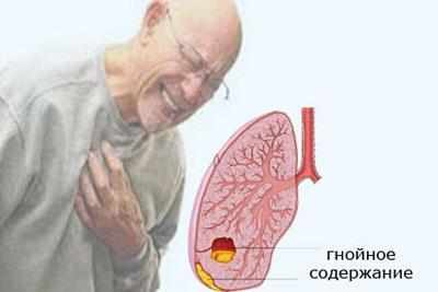 Абсцесс легкого