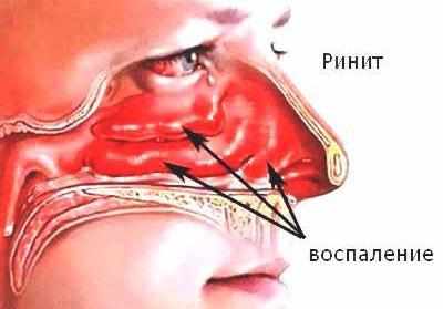 Воспаление при рините