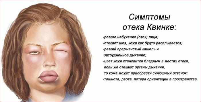 Симптомы отека Квинке