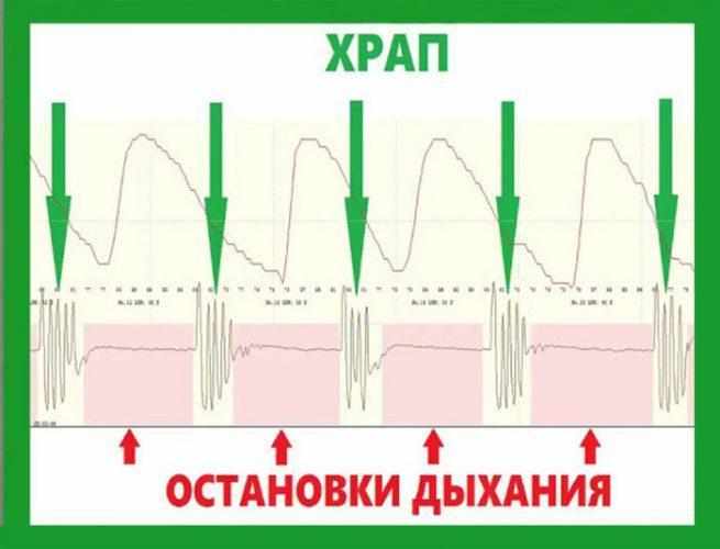 Остановки дыханеия при храпе