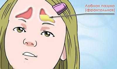 Фронтит у ребенка