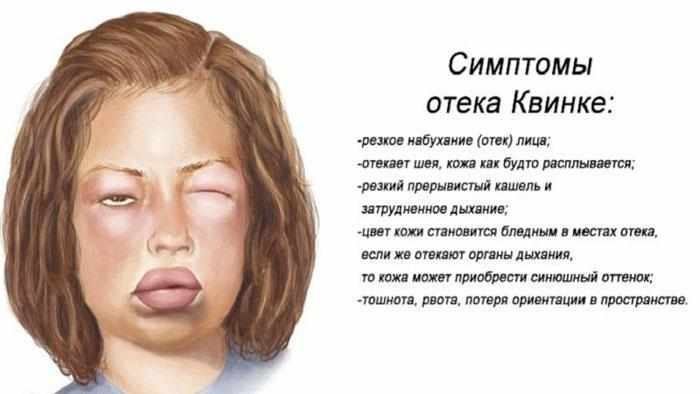 Симптомы отёка Квинке