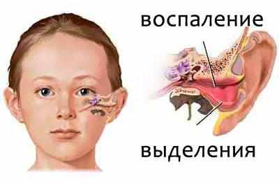 Отит у ребенка