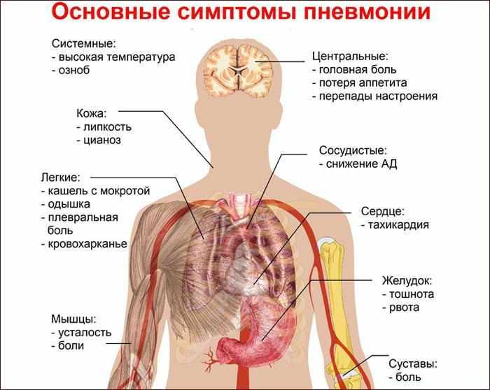 основные симптомы пневмонии