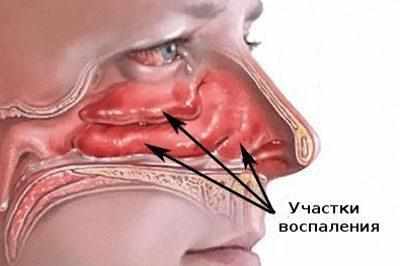 Воспаление при синусите