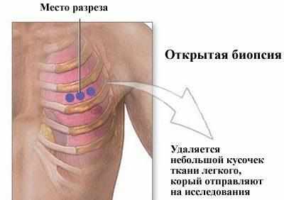 Открытая биопсия