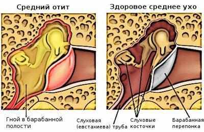 Воспаление уха