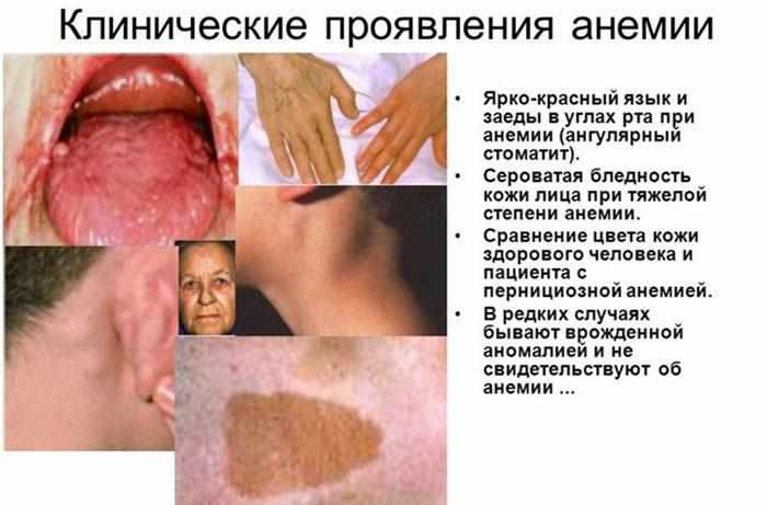 Симптомы анемии