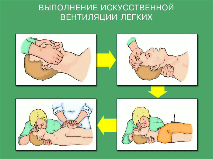 Искуственная вентиляция легких презентация