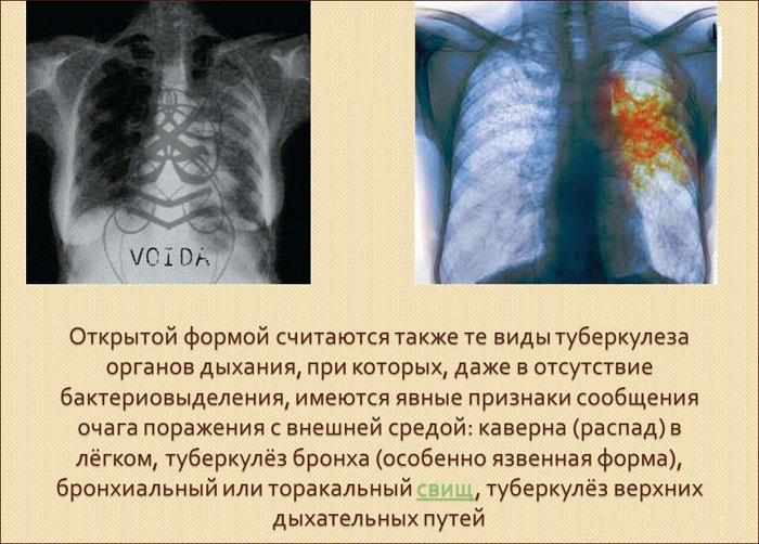 Открытая форма туберкулеза