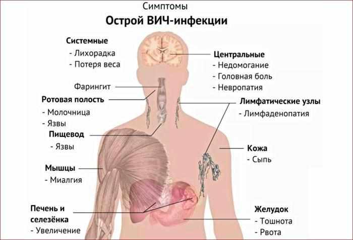 Признаки ВИЧ-инфекции