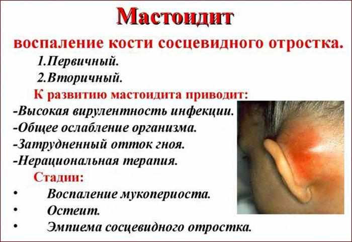Симптомы мастоидита
