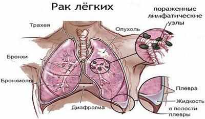 Рак легких с метастазами