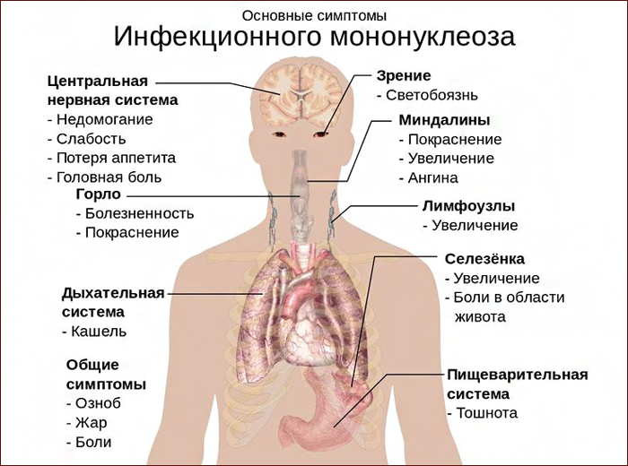 Симптомы мононуклеоза