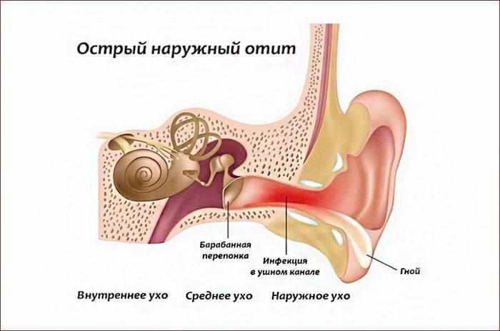 симптомы наружного отита