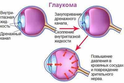 Следствие глаукомы