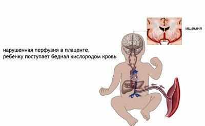 Гипоксия плода