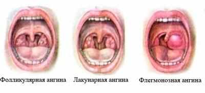 Формы ангины