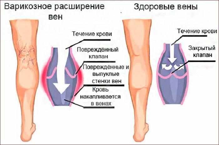 Симптомы варикоза