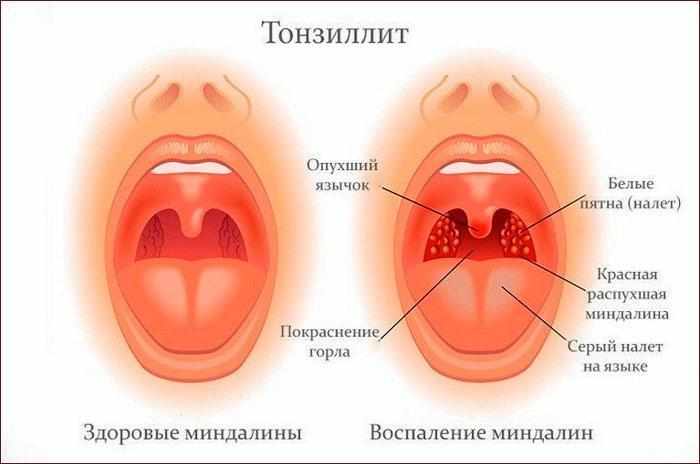Симптомы ангины
