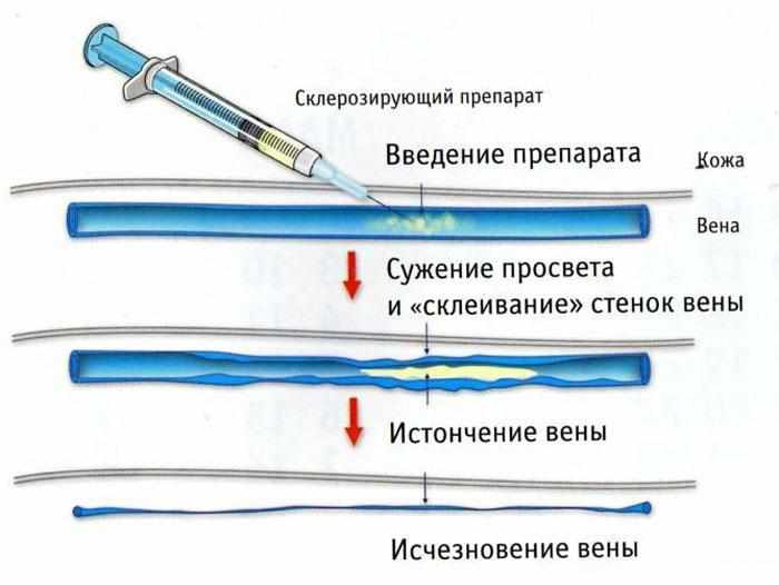 Механизм склерозирования