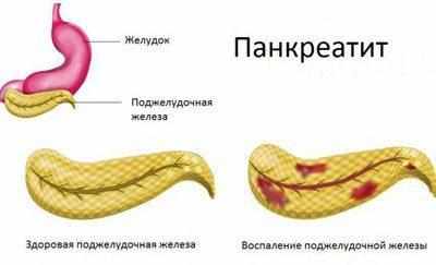Проявление панкреатита