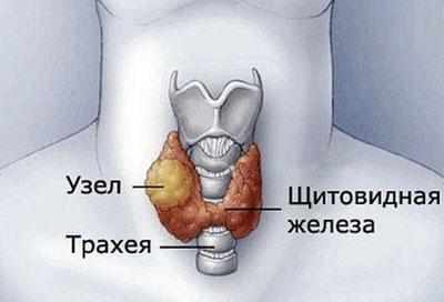 Заболевание щитовидной железы