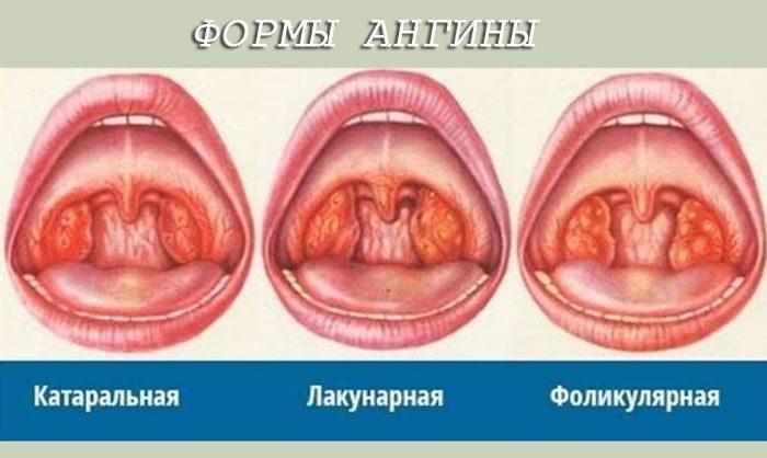 Формы ангины