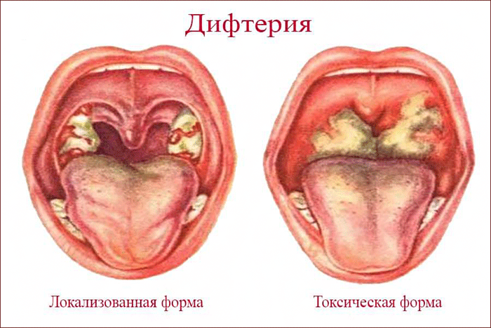 симптомы дифтерии