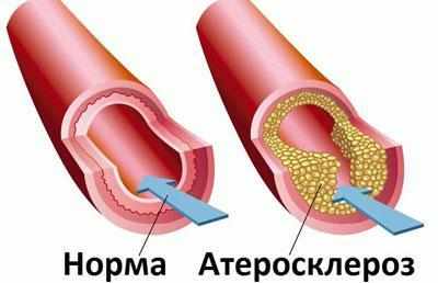 Сосуд при атеросклерозе