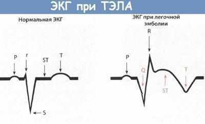 ЭКГ при тэла