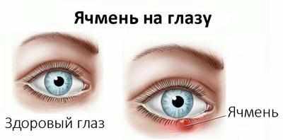 Ячмень на глазу
