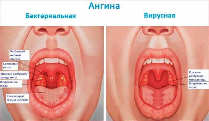 симптомы ангины