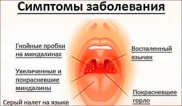 Симптомы ангины