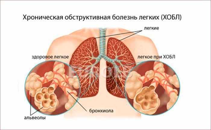 Признаки ХОБЛ