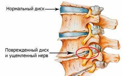 Проявление остеохондроза