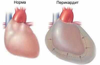 Симптомы перикардита