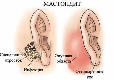Проявление мастоидита