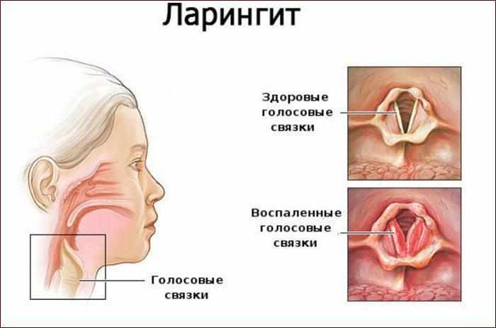 Проявление ларингита