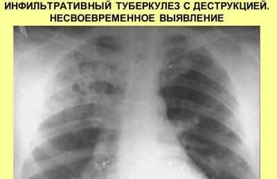 Запущенный туберкулез