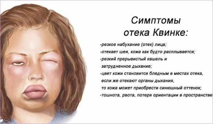 Симптомы отека квинке