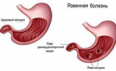 Язвенная болезнь