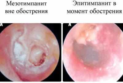 Проявление мезитимпанита