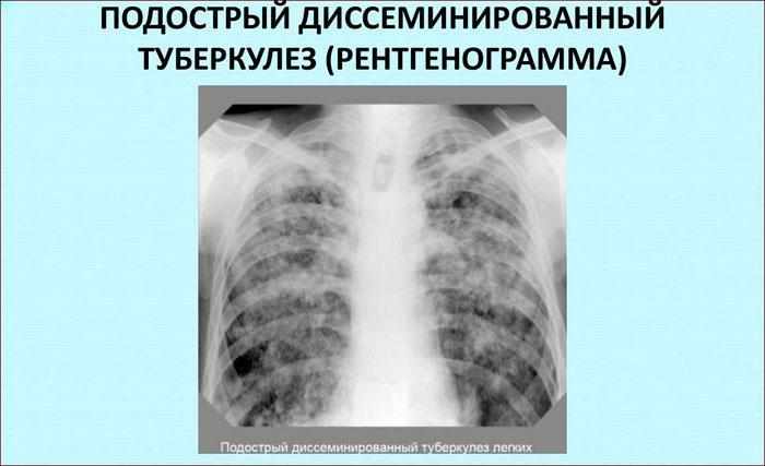 Диссеминированный туберкулёз лёгких