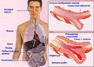 Симптомы муковисцидоза
