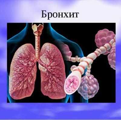 Бронхит