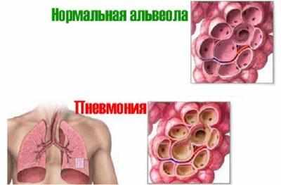 Альвеолы при пневмонии