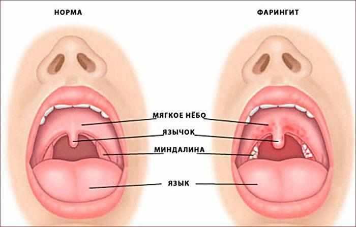 Симптомы фарингита