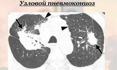 Узловой пневмокониоз