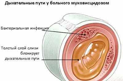 Дыхательные пути при муковисцидозе